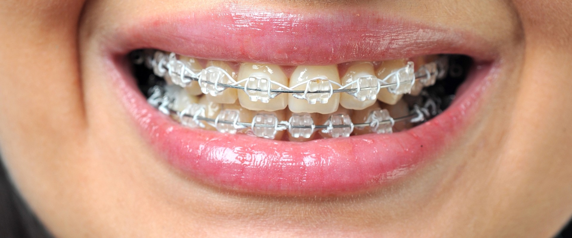 Transform Your Smile with LightForce Braces in Mill Creek