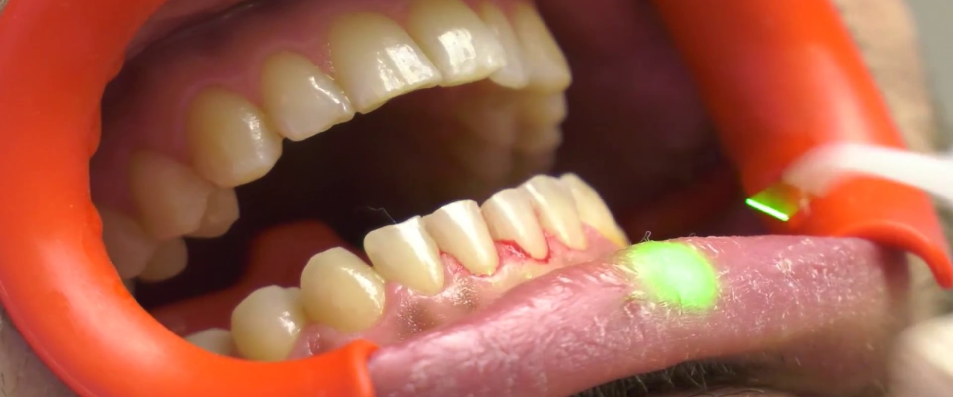 What is laser dental cleaning?