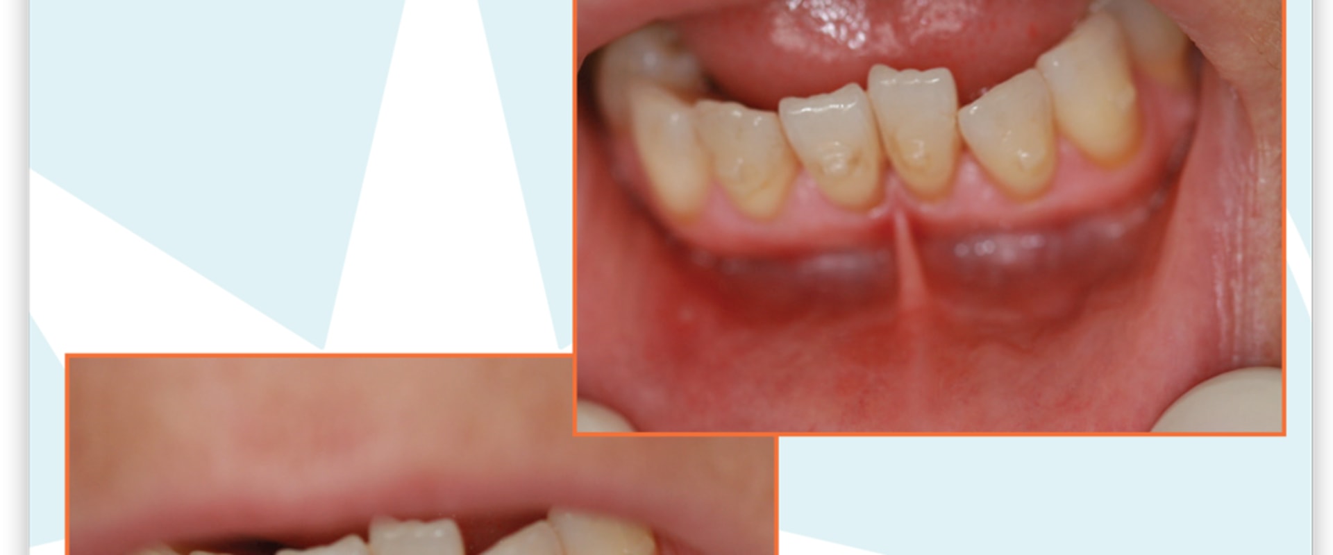 Maximizing Invisalign Results With Laser Dentistry In San Antonio