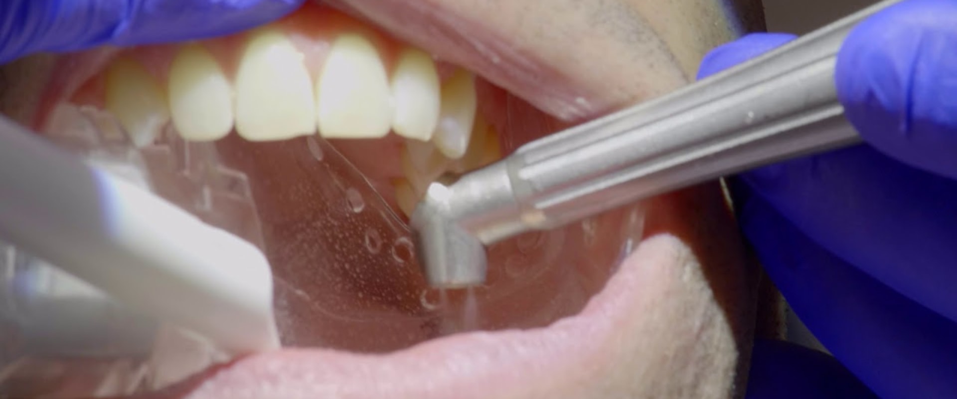 What is solea laser dentistry?