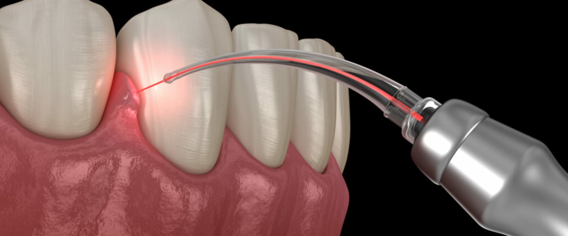 What is soft tissue laser dentistry?