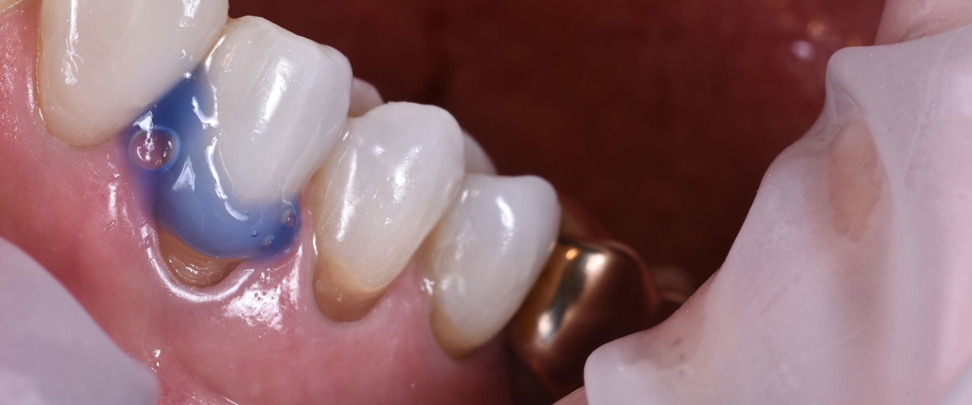 Transforming Dental Treatments: How A Dentist In Conroe, TX Embraces The Power Of Laser Dentistry
