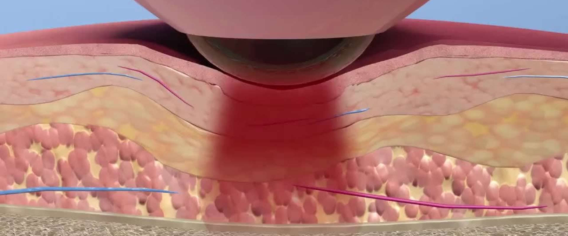 How laser works on soft tissue?