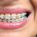 Transform Your Smile with LightForce Braces in Mill Creek