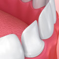 Laser Versatility In Georgetown Cosmetic Dentistry And Its Application In Porcelain Veneers
