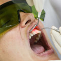 Reasons To Choose Laser Dentistry For Your Dental Care In Mansfield