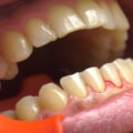 What is laser dental cleaning?