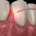 How Laser Dentistry Helps Treat Gum Disease Without Surgery