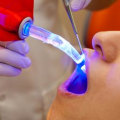 Laser Dentistry For Kids In Brambleton, VA: Everything Parents Should Know