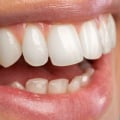 Maximizing The Benefits Of Laser Dentistry For Porcelain Veneer Placement In McGregor, TX