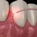 Are lasers safe in dentistry?