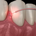 What kind of lasers do dentists use?