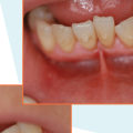 Maximizing Invisalign Results With Laser Dentistry In San Antonio
