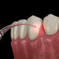 What is soft tissue laser dentistry?