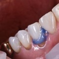 Transforming Dental Treatments: How A Dentist In Conroe, TX Embraces The Power Of Laser Dentistry