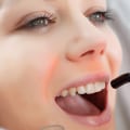 Is laser treatment good for teeth?