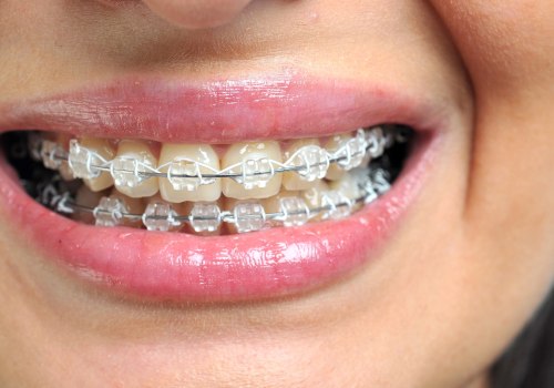 Transform Your Smile with LightForce Braces in Mill Creek