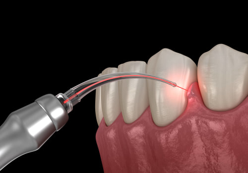 How Laser Dentistry Helps Treat Gum Disease Without Surgery