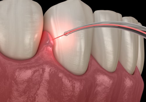 What is laser dental implant?
