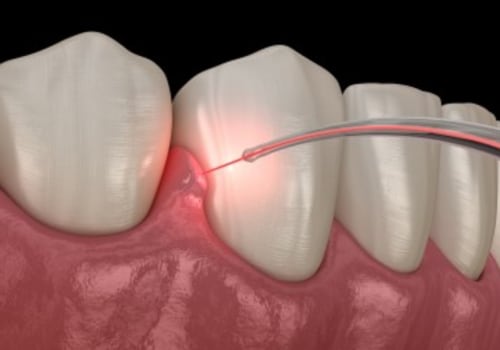 Is laser dentistry expensive?