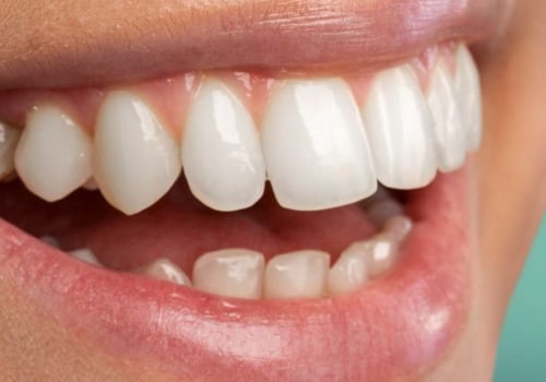 Maximizing The Benefits Of Laser Dentistry For Porcelain Veneer Placement In McGregor, TX