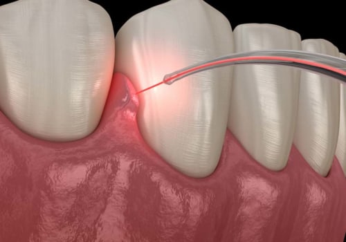 How To Get A Painless Dental Procedure With Laser Dentistry In Allen